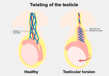Illustration showing a healthy testicle and one with a twisted spermatic cord