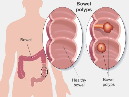 Bowel polyps