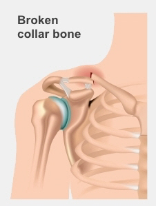 Broken collar bone is above the ribs and shoulder, under the neck