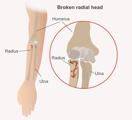 Broken radial head
