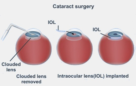 Cataract surgery