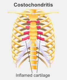 Costochondritis showing the inflamed costal cartilage, which joins your ribs to your breastbone