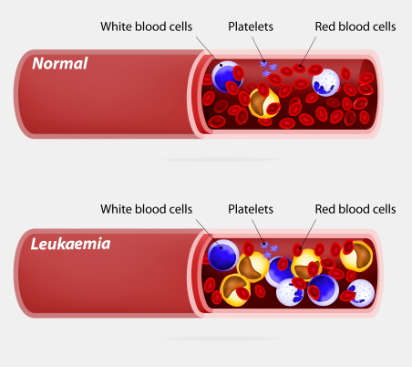 Leukaemia graphic