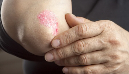 Psoriasis elbow