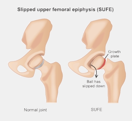A normal hip joint and one with a SUFE. The ball of the thigh bone has slipped down, with a gap between the ball and the rest of the thigh bone