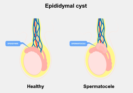 Illustration showing a healthy testicle and one with a cyst in the epididymis